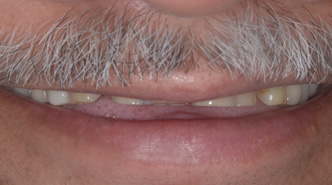 Minimally Visible Upper Front Teeth Dental Veneers in Mumbai